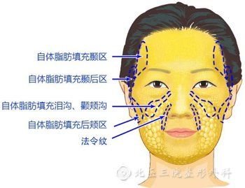 北醫(yī)三院整形外科面部脂肪填充部位