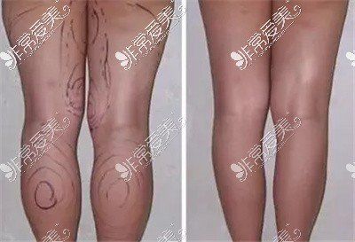 維密吸脂大腿對比