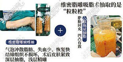 維密吸脂和普通吸脂對比