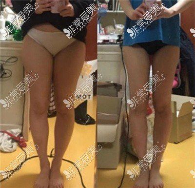 維密吸脂和普通吸脂大腿吸脂對比