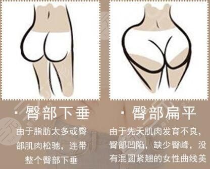 臀部吸脂塑形適合哪些人