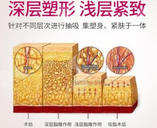 臀部吸脂塑形手術(shù)優(yōu)點(diǎn)