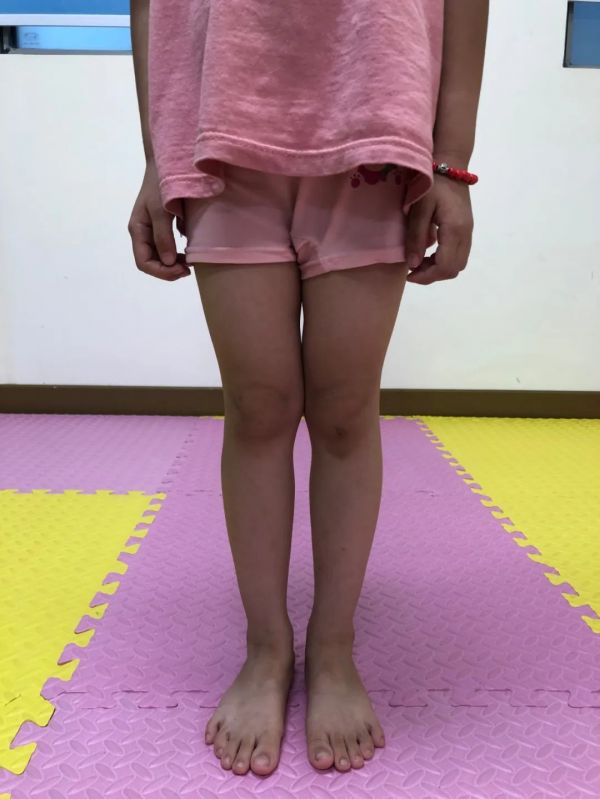 孩子是「X 型腿」？先別慌！簡(jiǎn)單幾招就可以改善