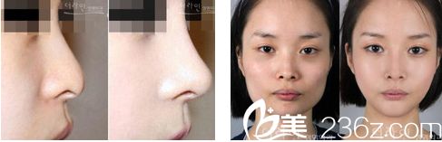 德萊茵整形外科醫(yī)院隆鼻案例
