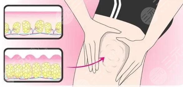 常見(jiàn)的減肥方法