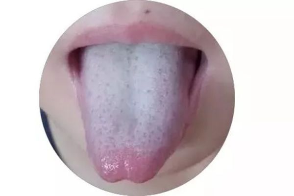 薄白苔圖