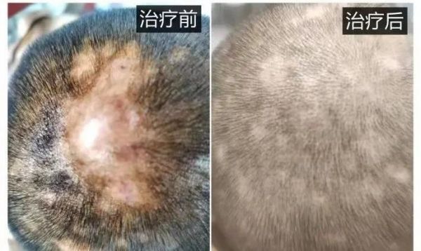 名醫(yī)說 | 名中醫(yī)王利蘭：毛囊炎，分階段、內(nèi)調(diào)外治是核心！