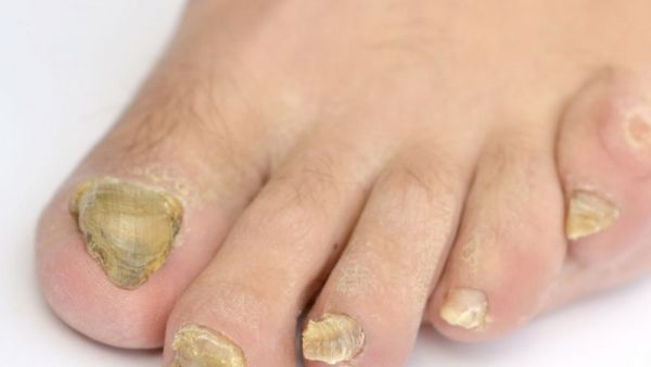 脚指甲不平怎么回事