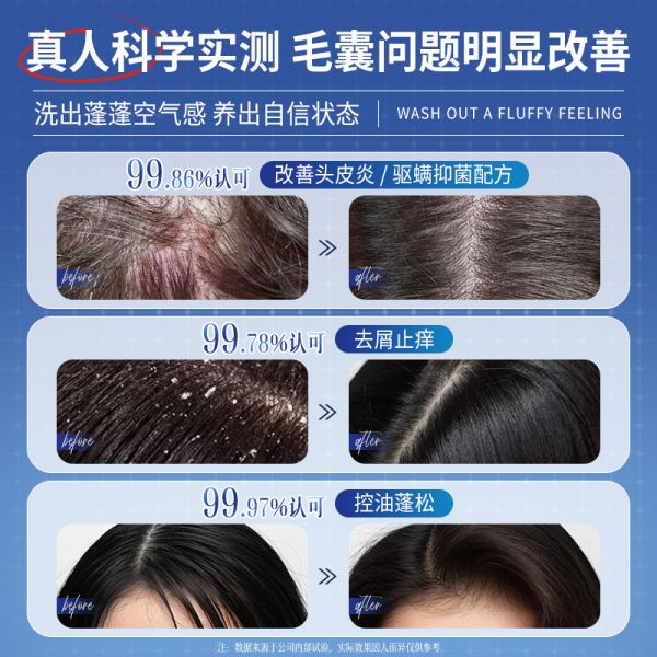 【若安好洗发水50】头皮不健康如何调养：二硫化硒洗发水液去屑止痒控油蓬松洗头膏毛囊清洁炎露男女非除螨45761