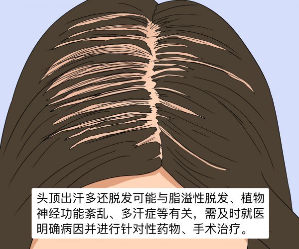 頭頂出汗多還脫發(fā)是怎么回事怎么辦.jpg