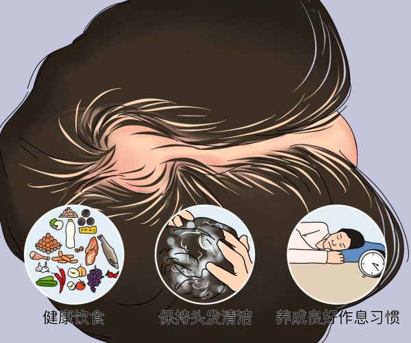 脂溢性脫發(fā)怎么調(diào)理最有效.jpg