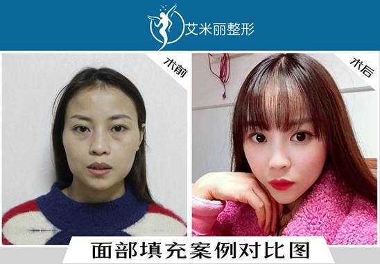 艾米麗脂肪填充專利針真實效果案例展示