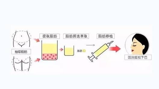 艾米麗脂肪填充專利針真實效果案例展示