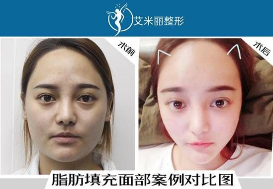 艾米麗脂肪填充專利針真實效果案例展示