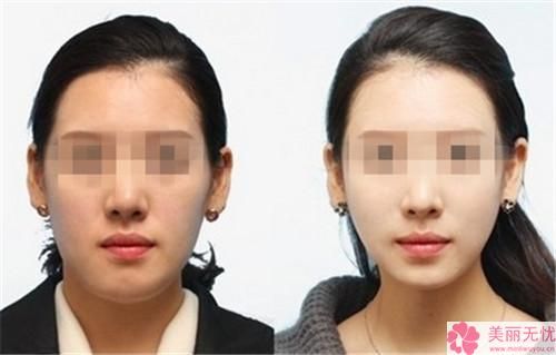 如何辨别粉毒瘦脸针的真伪