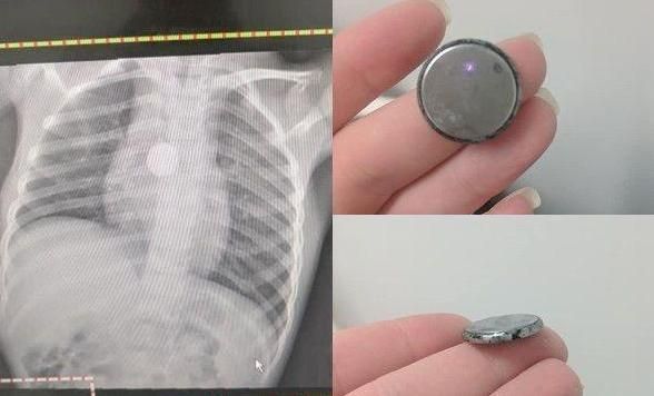 5岁女儿突然暴瘦，拍片时医生让孩子摘下项链，妈妈：她没戴项链