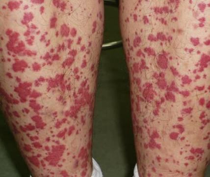 血小板减少性紫癜是什么呢