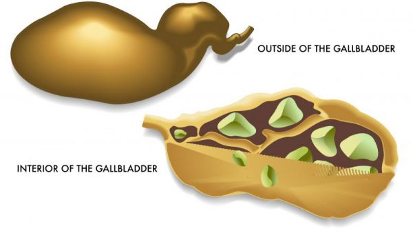 膽結(jié)石的癥狀