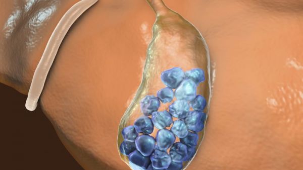 膽結(jié)石引發(fā)原因