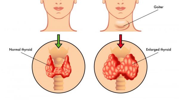 亚急性甲状腺炎怎么治疗