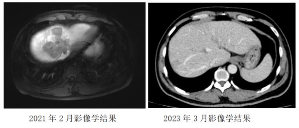 2年带瘤生存 前后对比.png