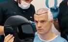 中年男人的痛瑞士媒體：32歲扎卡接受了植發(fā)手術