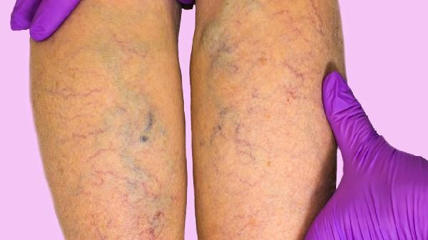 一个人水肿会重多少斤