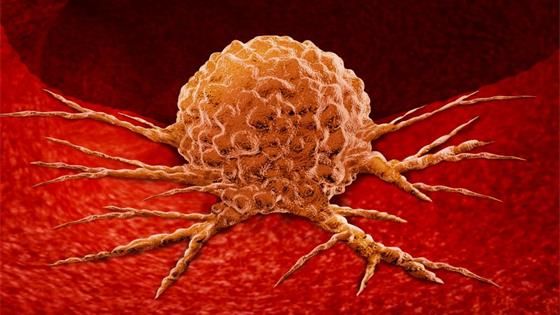 什么是肿瘤？恶性肿瘤=癌症？教你正确区分癌症与肿瘤