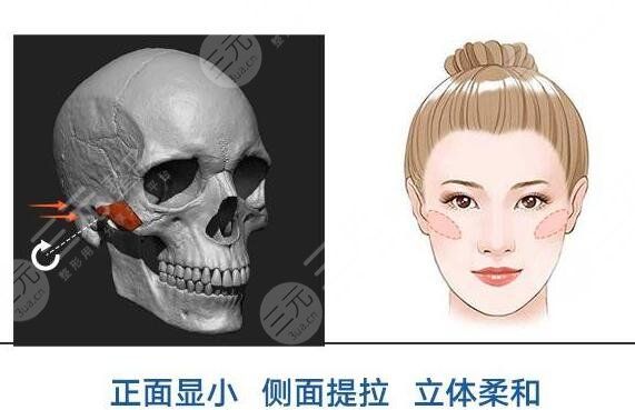 顴骨整形術(shù)危險(xiǎn)嗎?