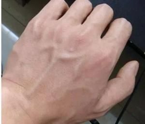 手上有明顯青筋，是靜脈曲張嗎？心血管外科主任：中老年人要注意