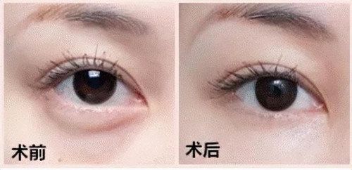 華美整形做眼袋多少錢？華美整形醫(yī)院眼部整形價(jià)格表2025