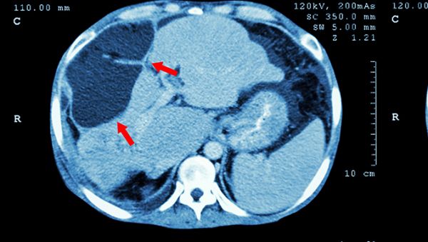 什么是癌胚（糖鏈）抗原ca72-