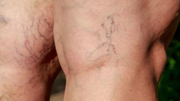 腿粗屁股大怎么減