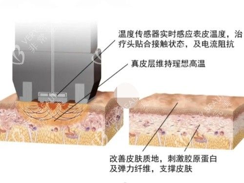 鉆石超塑整形原理示意圖
