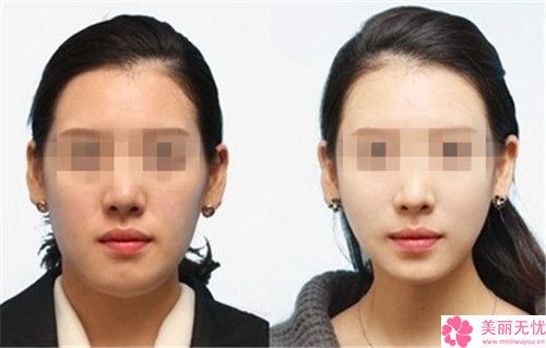 成都玉之光醫(yī)療美容beau瘦臉針有副作用嗎如何護(hù)理