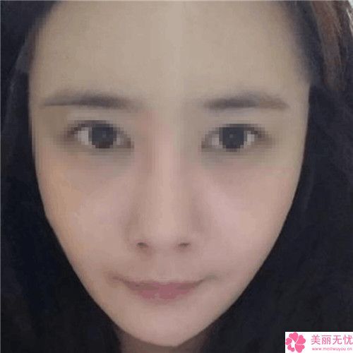 成都玉之光醫(yī)療美容beau瘦臉針有副作用嗎如何護(hù)理