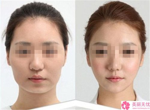 成都玉之光醫(yī)療美容beau瘦臉針有副作用嗎如何護(hù)理