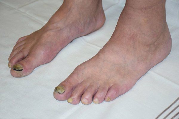 甲癬怎么治療用什么藥膏