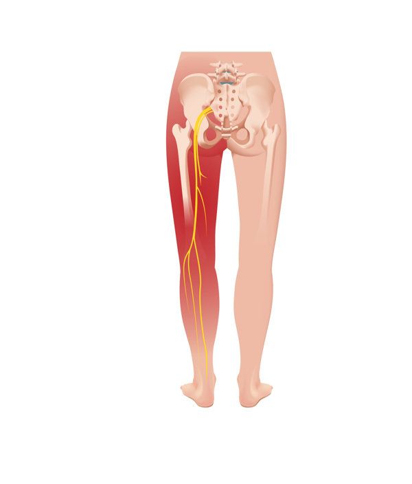 坐骨神經(jīng)痛怎么引起