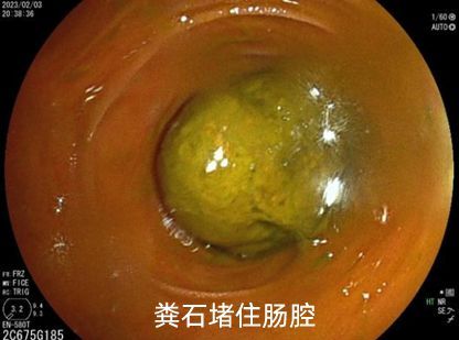 女子節(jié)食暴瘦44斤想“餓死”腫瘤
