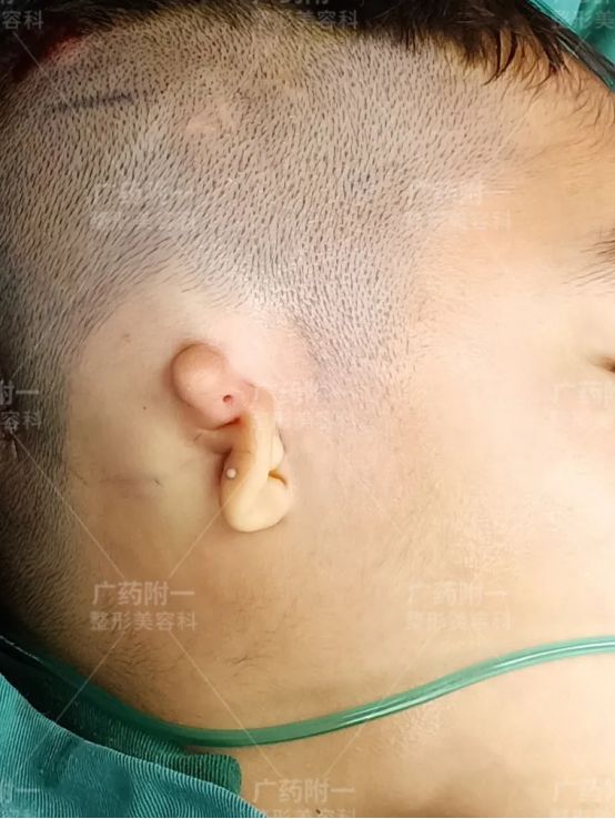 小耳畸形孩子幾歲做耳再造最好？廣藥附一余文林主任解答