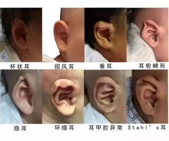 小耳畸形孩子幾歲做耳再造最好？廣藥附一余文林主任解答
