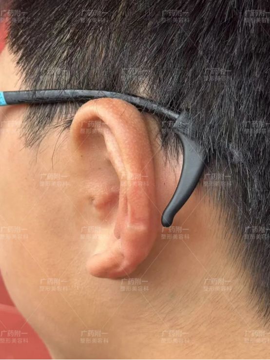 小耳畸形孩子幾歲做耳再造最好？廣藥附一余文林主任解答