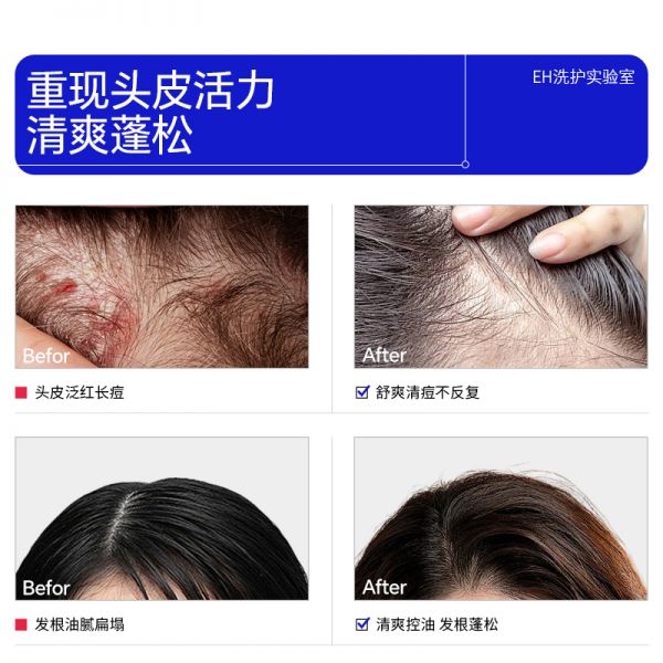 【若安好洗發(fā)水41】名臣健康洗發(fā)水怎么樣:EHD祛痘洗發(fā)水去屑控油蓬松養(yǎng)發(fā)毛囊洗頭膏洗發(fā)露正品59712