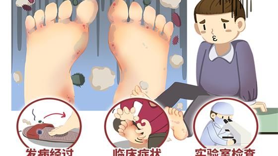 怎么判斷是不是腳氣