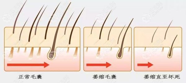 正常毛囊与不正常毛囊的对比