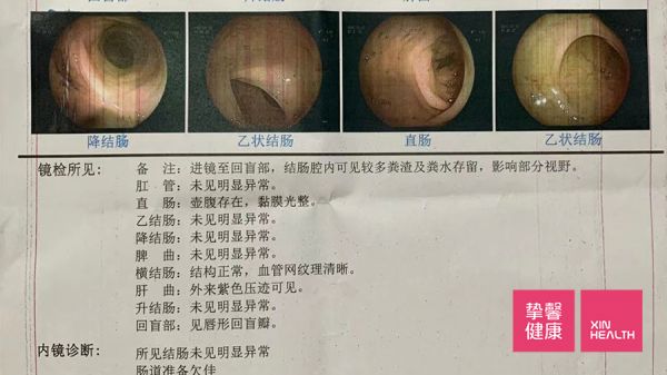 國內(nèi)腸鏡檢查 圖片不清晰