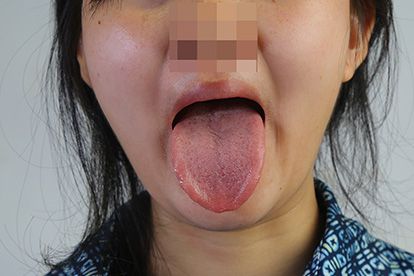 舌頭正常圖片