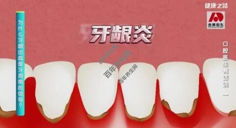 牙齦炎