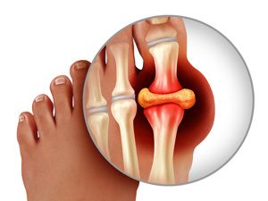 本地公開：北京蘇敬達大腳骨手術(shù)怎么樣？微孔祛大腳骨技術(shù)切口小，恢復期短，術(shù)后就能行走，價格還不貴~